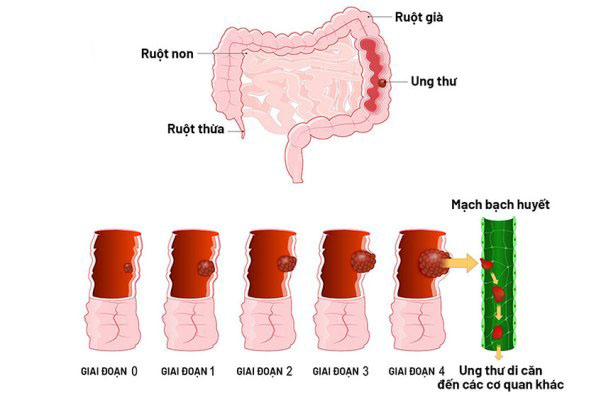 Các giai đoạn ung thư đại tràng