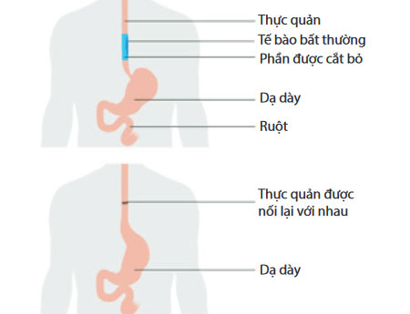 Phẩu thuật ung thư thực quản